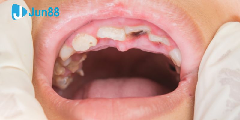 Những nguyên nhân khiến bạn nằm mộng thấy mình rụng răng